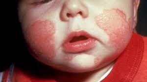 Chàm và dị ứng da bệnh thường gặp ở mọi lứa tuổi.